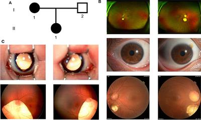 A Heterozygous Novel Mutation in TFAP2A Gene Causes Atypical Branchio-Oculo-Facial Syndrome With Isolated Coloboma of Choroid: A Case Report